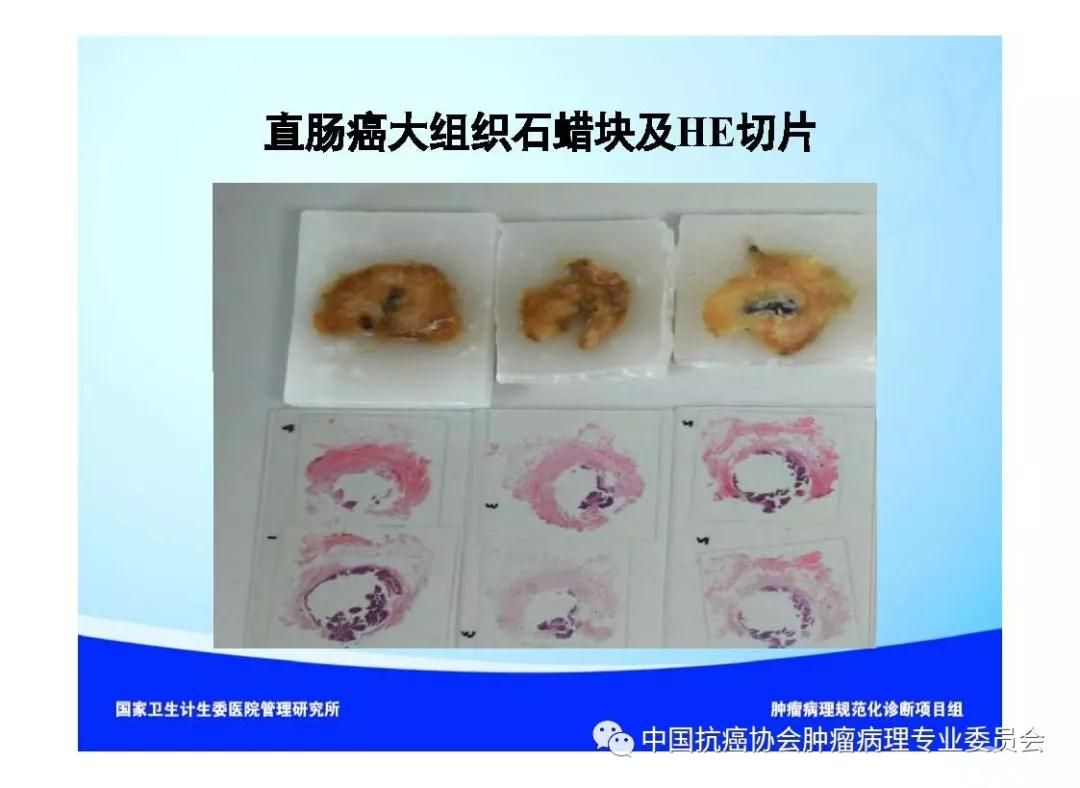 肿瘤病理诊断规范 第9部分:结直肠癌病理诊断规范