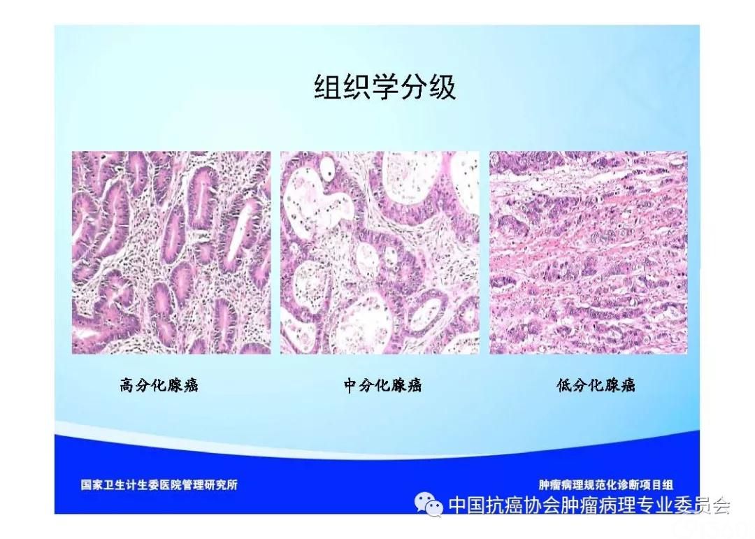 肿瘤病理诊断规范 第9部分:结直肠癌病理诊断规范