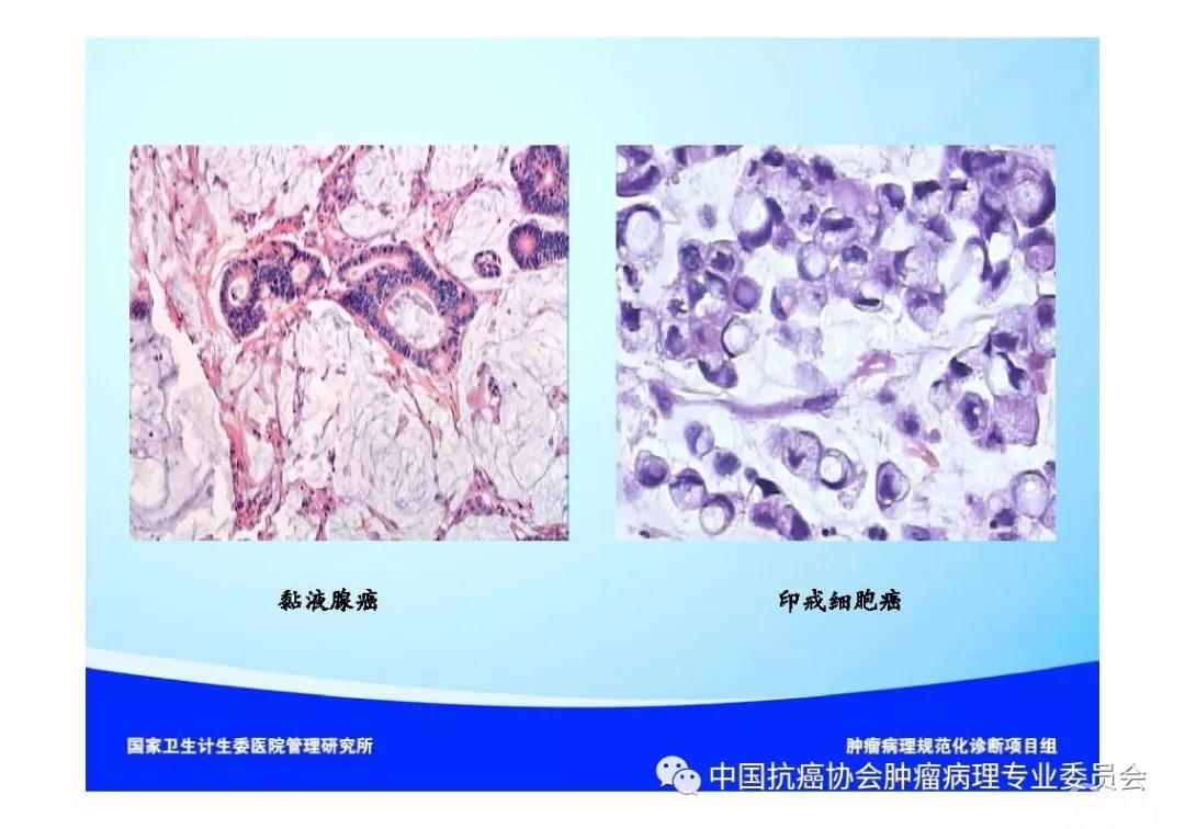 肿瘤病理诊断规范 第9部分:结直肠癌病理诊断规范
