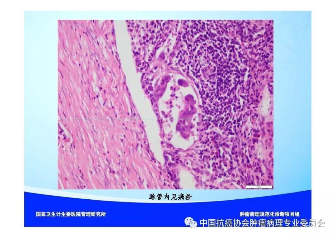 肿瘤病理诊断规范 第9部分:结直肠癌病理诊断规范