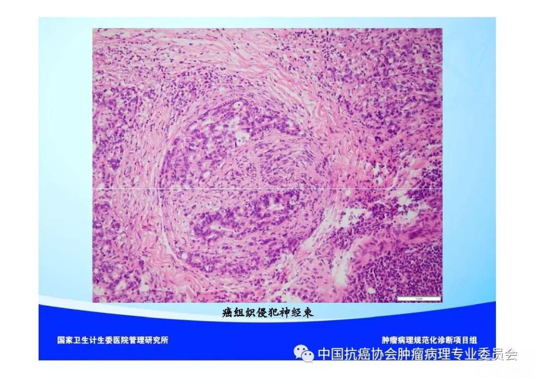 肿瘤病理诊断规范 第9部分:结直肠癌病理诊断规范