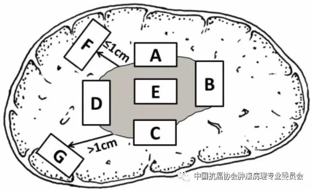 肿瘤病理诊断规范 第8部分:肝癌病理诊断规范