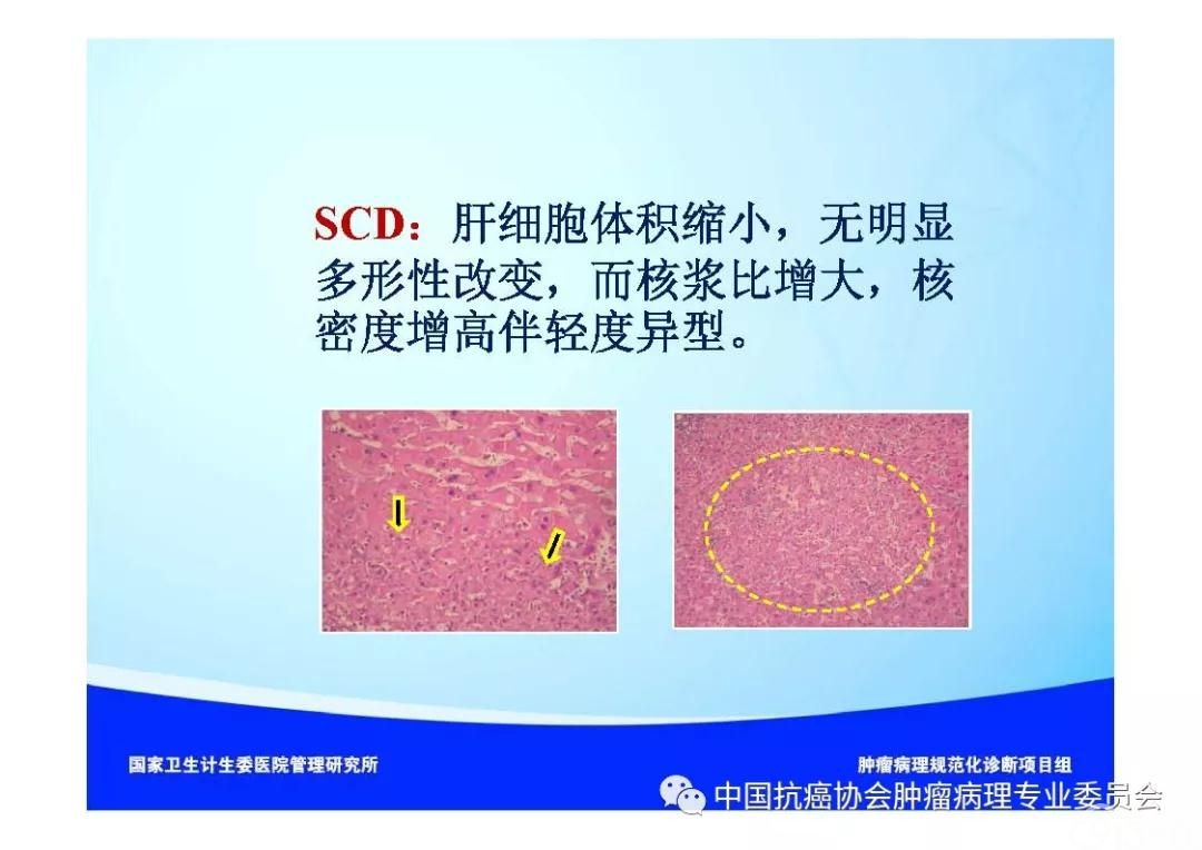 肿瘤病理诊断规范 第8部分:肝癌病理诊断规范
