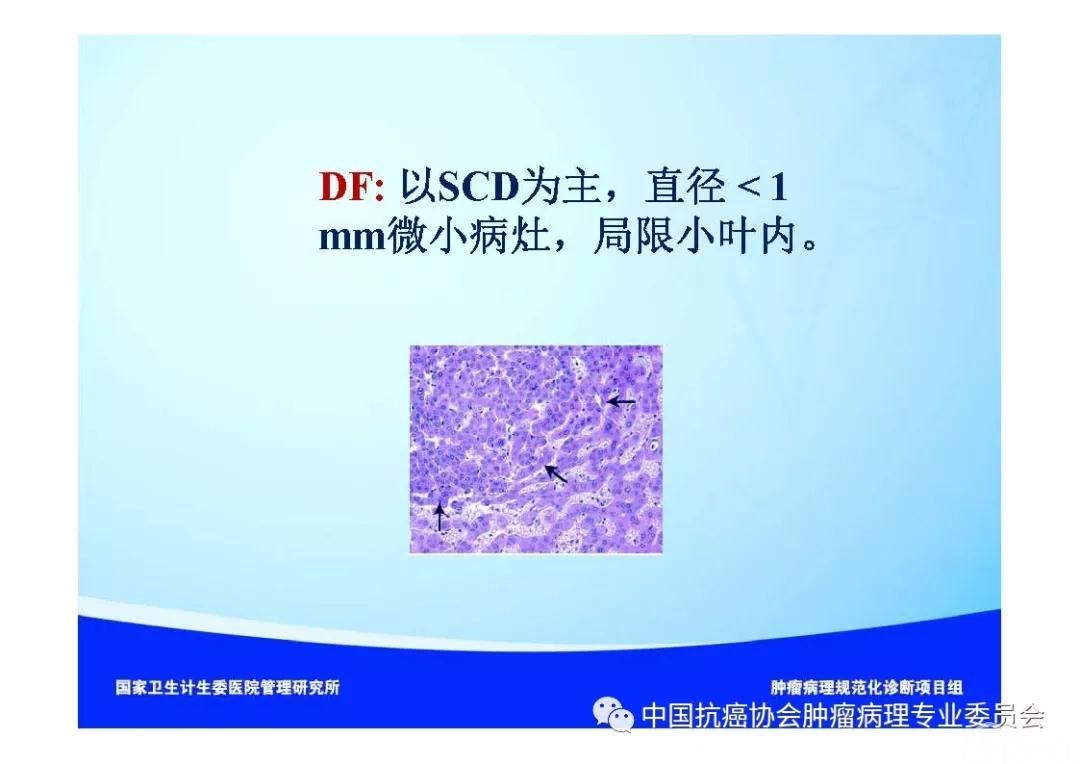 肿瘤病理诊断规范 第8部分:肝癌病理诊断规范