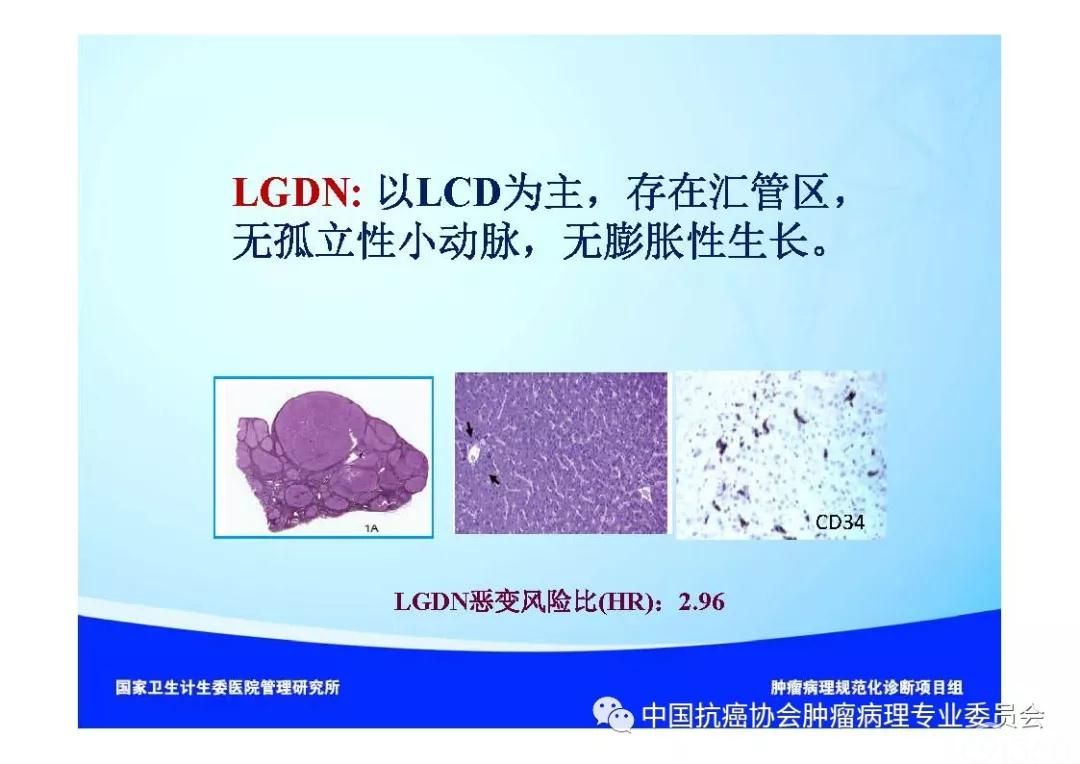 肿瘤病理诊断规范 第8部分:肝癌病理诊断规范