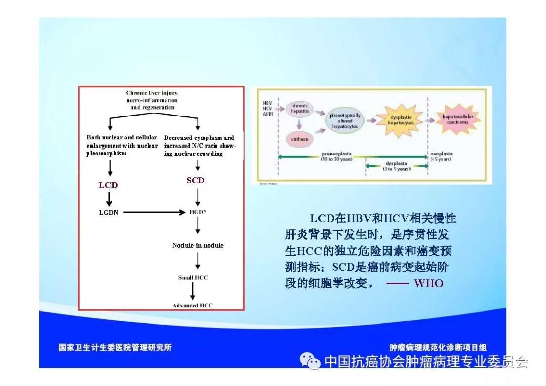 肿瘤病理诊断规范 第8部分:肝癌病理诊断规范