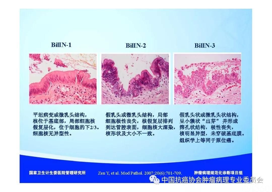 肿瘤病理诊断规范 第8部分:肝癌病理诊断规范