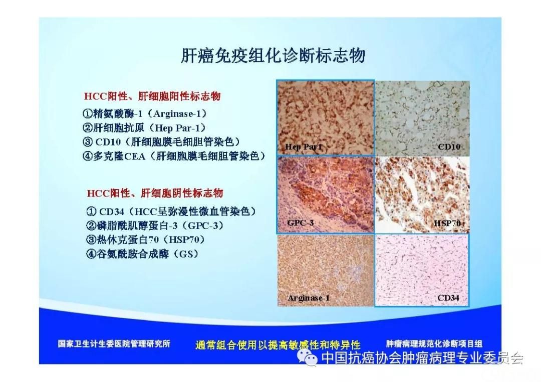 肿瘤病理诊断规范 第8部分:肝癌病理诊断规范