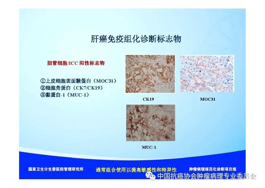 肿瘤病理诊断规范 第8部分:肝癌病理诊断规范