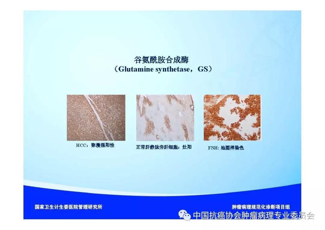 肿瘤病理诊断规范 第8部分:肝癌病理诊断规范