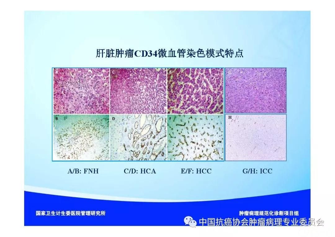 肿瘤病理诊断规范 第8部分:肝癌病理诊断规范