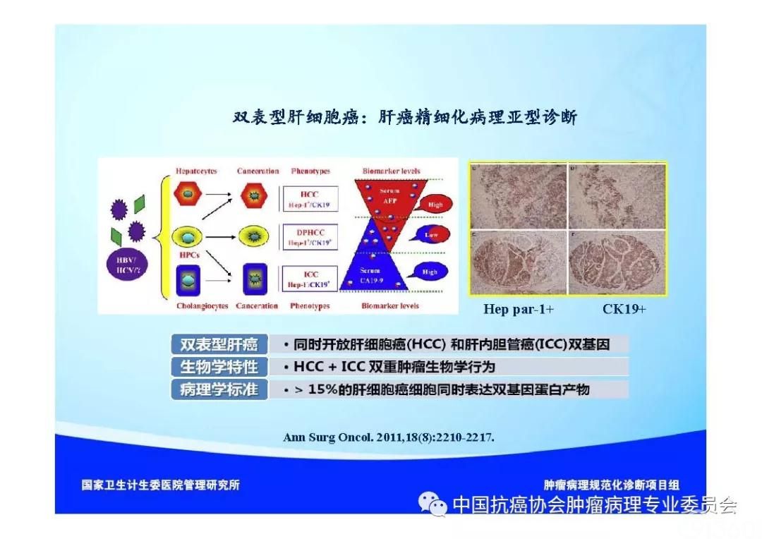 肿瘤病理诊断规范 第8部分:肝癌病理诊断规范