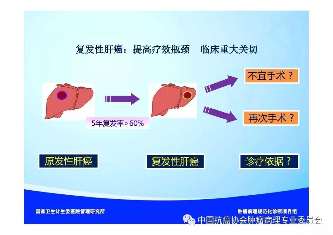 肿瘤病理诊断规范 第8部分:肝癌病理诊断规范