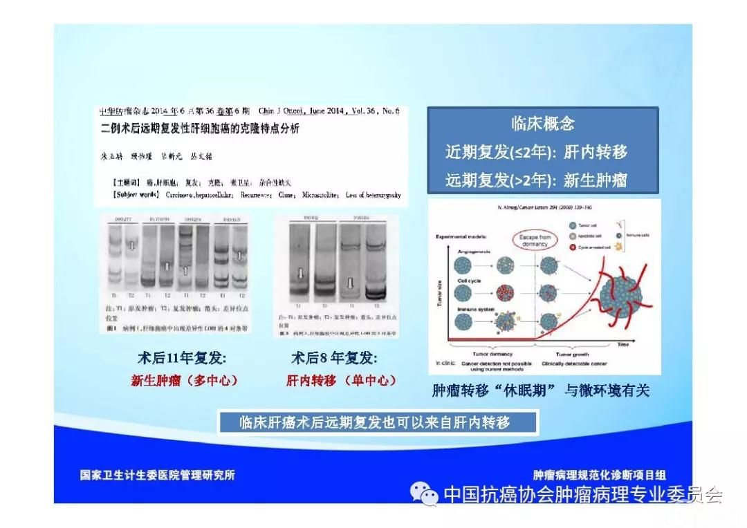 肿瘤病理诊断规范 第8部分:肝癌病理诊断规范