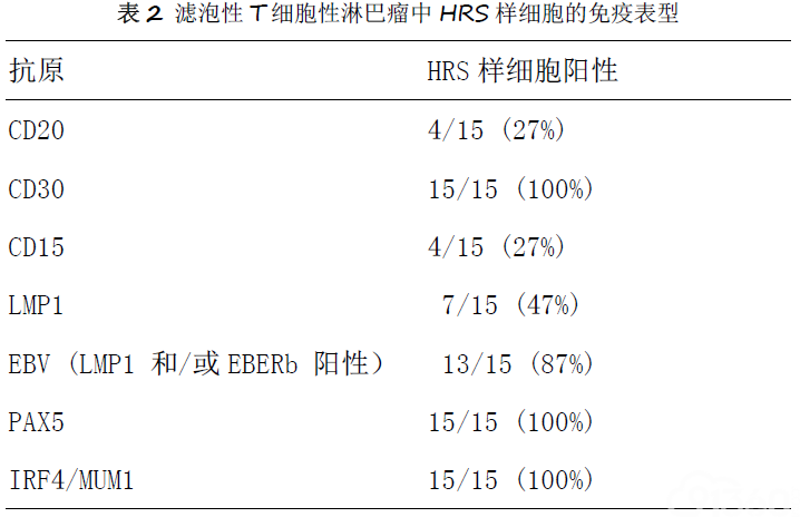 CD30在滤泡性T细胞淋巴瘤的肿瘤性T细胞表达是霍奇金淋巴瘤鉴别诊断中一种有帮助的诊断工具
