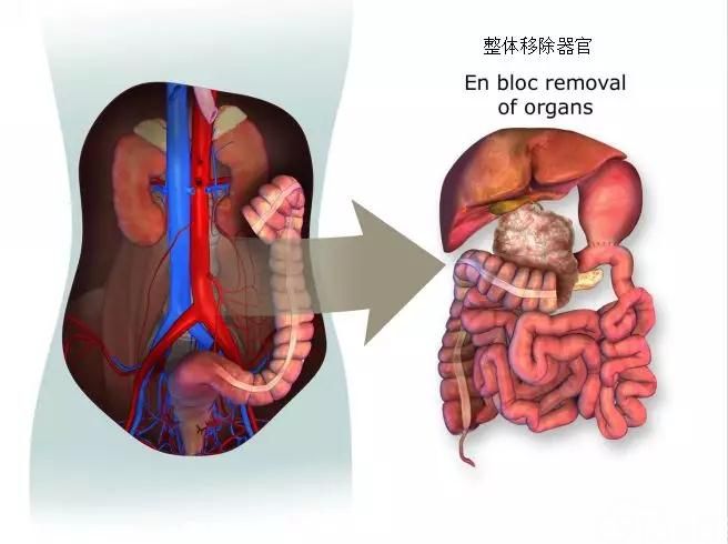 号称“癌症之王”的胰腺癌会不会遗传给下一代?
