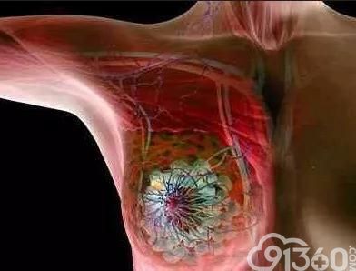 乳房肿块必定是乳腺癌?这篇文章给你答案!