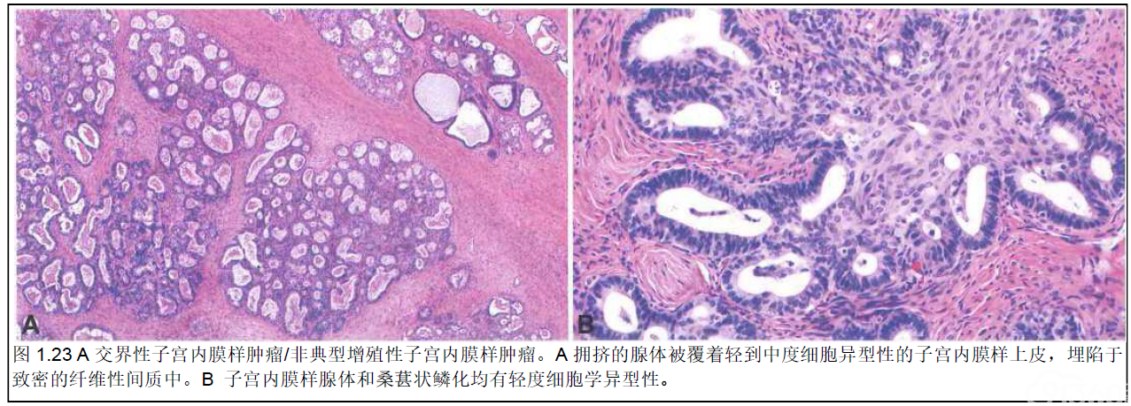 子宫内膜样癌 91360智慧病理网