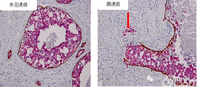 免疫组化在乳腺病理诊断中的应用