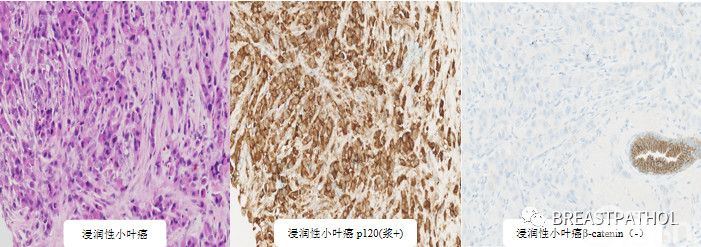 免疫组化在乳腺病理诊断中的应用