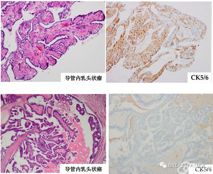 免疫组化在乳腺病理诊断中的应用