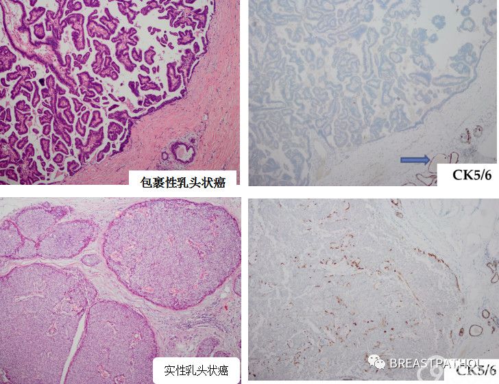 免疫组化在乳腺病理诊断中的应用
