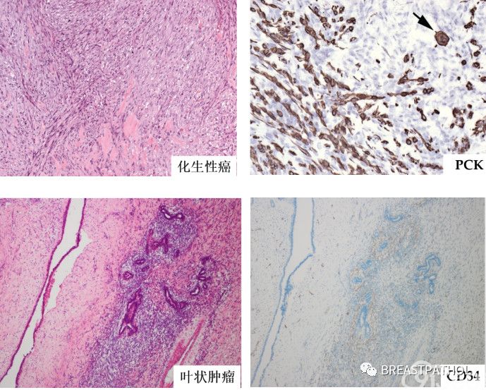 免疫组化在乳腺病理诊断中的应用