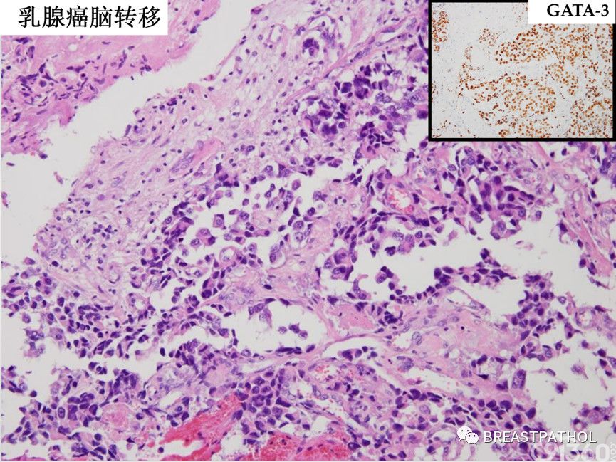 免疫组化在乳腺病理诊断中的应用