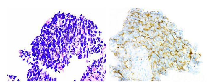 病例解析丨一个肺 两种癌 组织学不一致的同步性双侧肺癌 智慧病理网